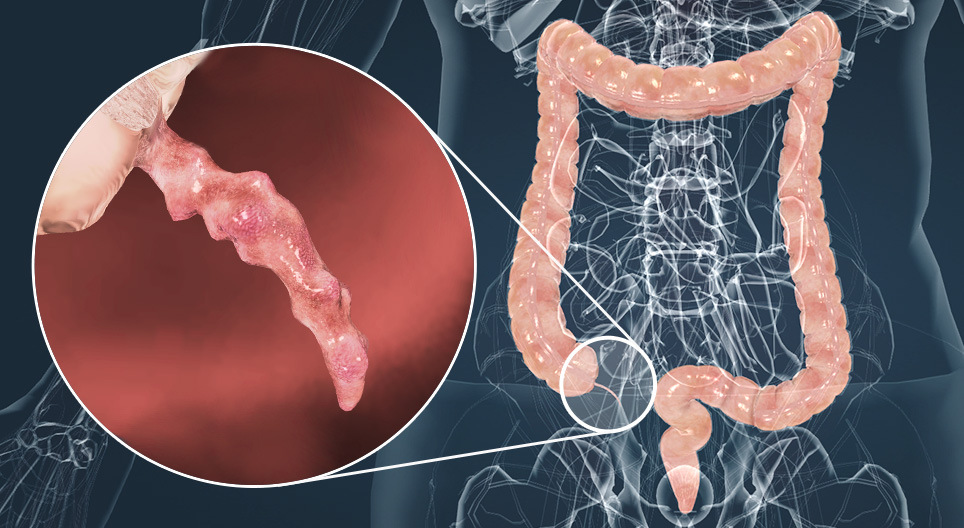 Apendicitis