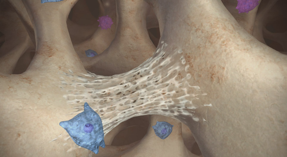 Osteoporosis