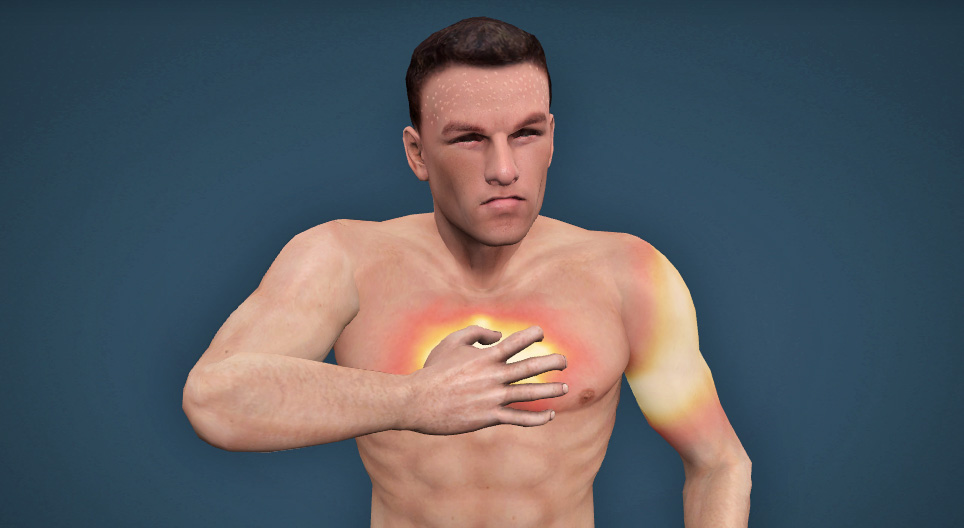 Infarto miocardico