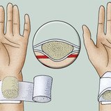 Mise d'une compresse