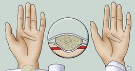 Anlegen eines Druckverbandes