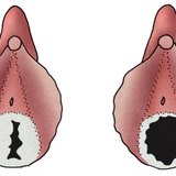 Maagdenvlies van een jong meisje (links) en van een seksueel actieve vrouw (rechts)