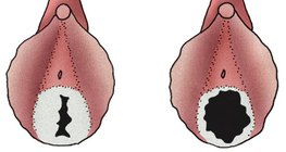 Hymen eines jungen Mädchens (links) und einer sexuell aktiven Frau (rechts)