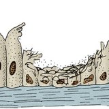 Flimmerepithel in den Atemwegen eines Rauchers