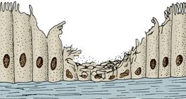 Flimmerepithel in den Atemwegen eines Rauchers