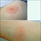Lyme-Borreliose