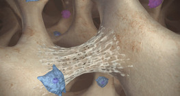 Osteoporosis