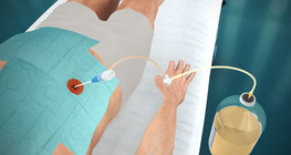 Paracentesis